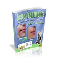 Acne Treatments!